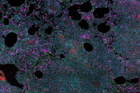 有腫瘤轉移的小鼠肺組織 用 4% PFA 固定並染色：腫瘤細胞 （RFP）、巨噬細胞 （siglecH-GFP）、T 細胞 （Ly6-G647） 和 DNA （DAPI）。 樣品由 H. Ishikawa-Ankerhold 提供，Walter-Brendel-Zentrum für Experimentelle Medizin München，德國