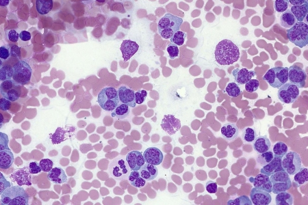 代表性人類血液影像，顯示白血病、Giemsa染色及透射光明場