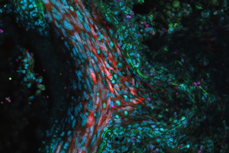 有腫瘤轉移的小鼠肺組織：用 4% PFA 固定並染色：腫瘤細胞 （RFP）、巨噬細胞 （siglecH-GFP）、T 細胞 （Ly6-G647） 和 DNA （DAPI）。