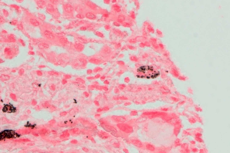 人類癌症組織 炭疽病，人類癌症組織中出現碳色素沉積（黑色）焦點區域（紅色）。 樣品提供：A. Feuchtinger，亥姆霍茲慕尼黑中心，德國